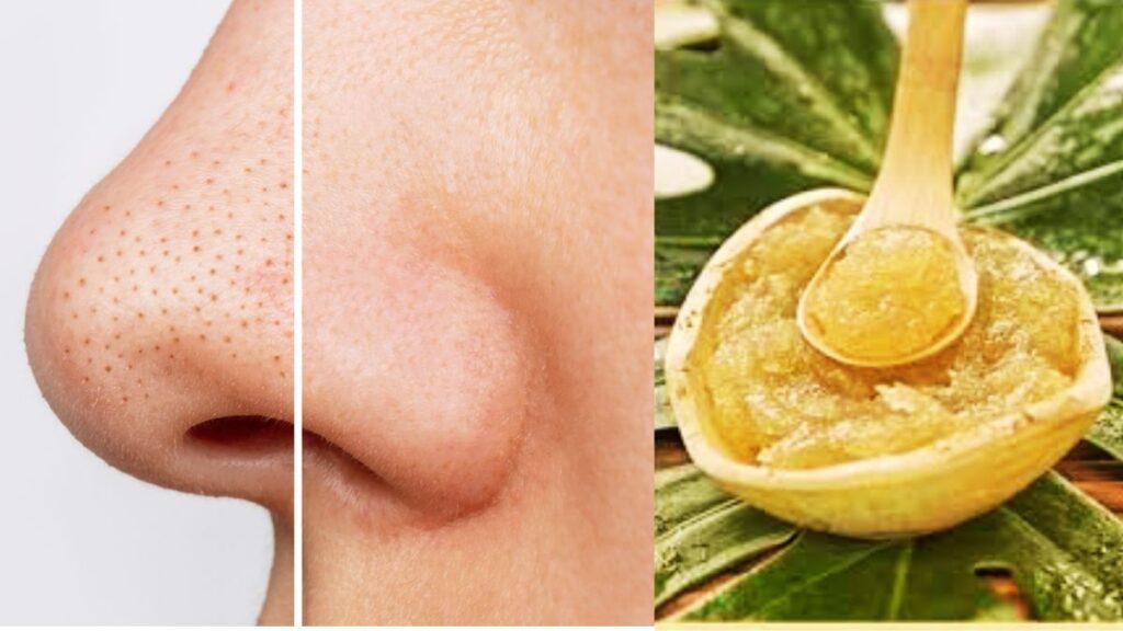 Home remedy for black heads