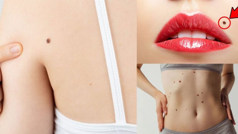 Moles on Body