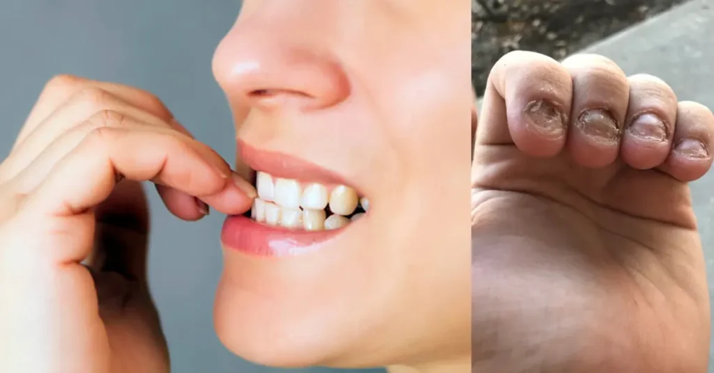 nail biting